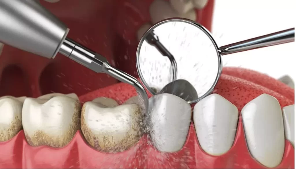 профессиональная чистка зубов