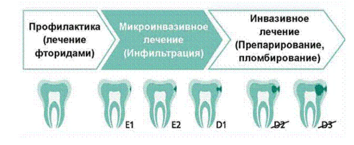 типы кариеса