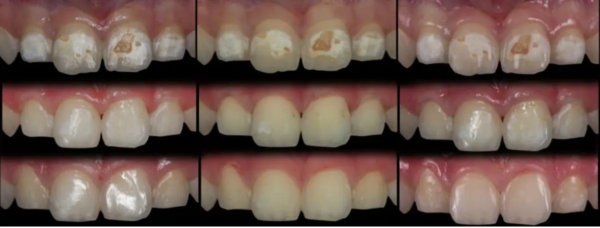 Пример лечения с помощью системы ICON