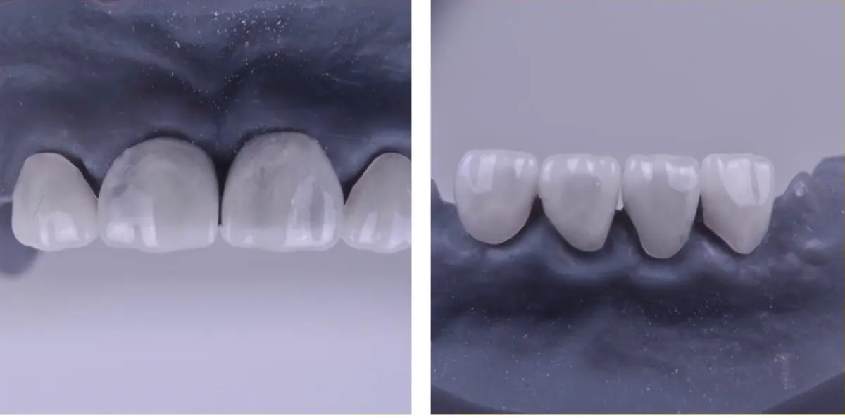 Коронки на молочные зубы, лабораторное изготовление