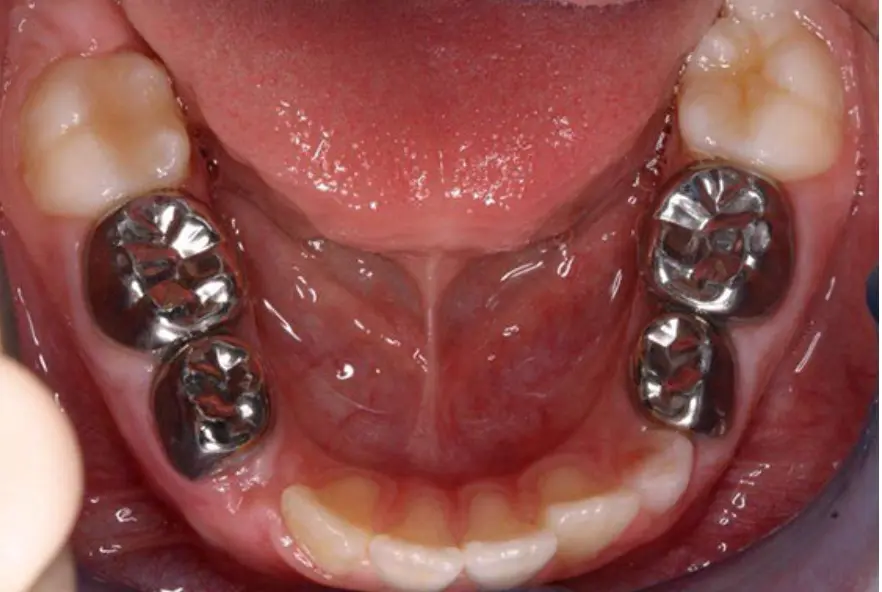 реставрация стандартными коронками