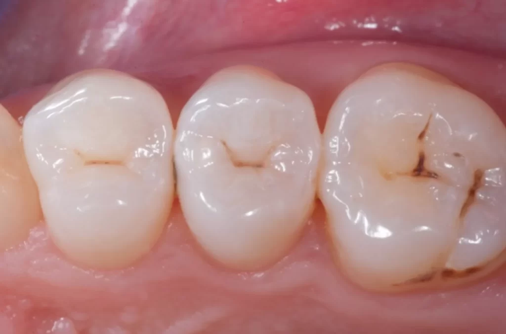 Фисуры пигментированы коричневым цветом