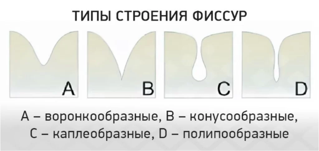типы строения фиссура