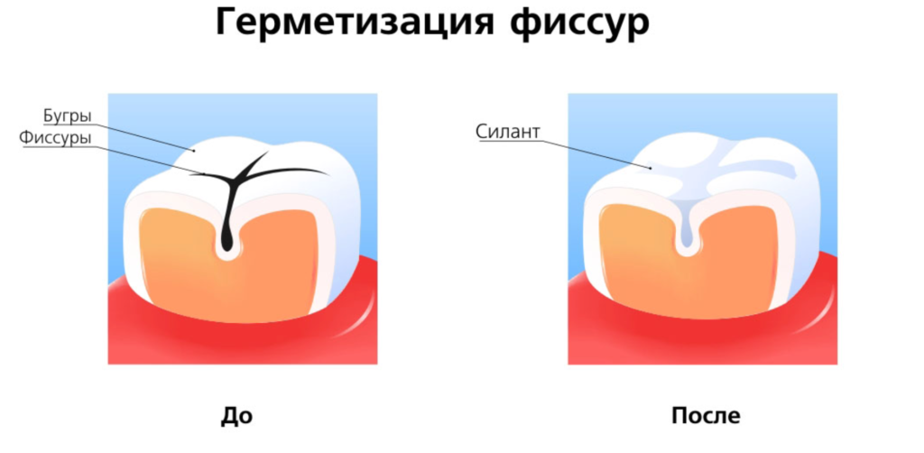 герметизация фиссура