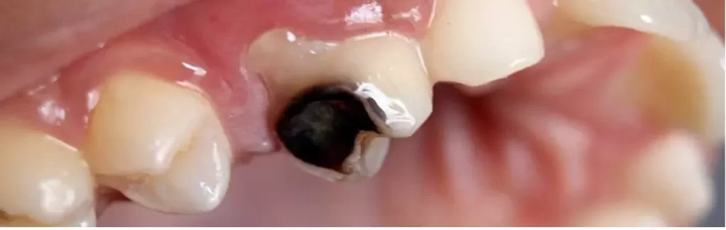 приклад глибокого карієсу