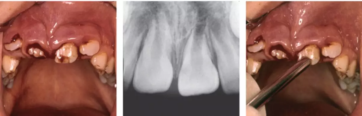 Пример вколоченного вывиха