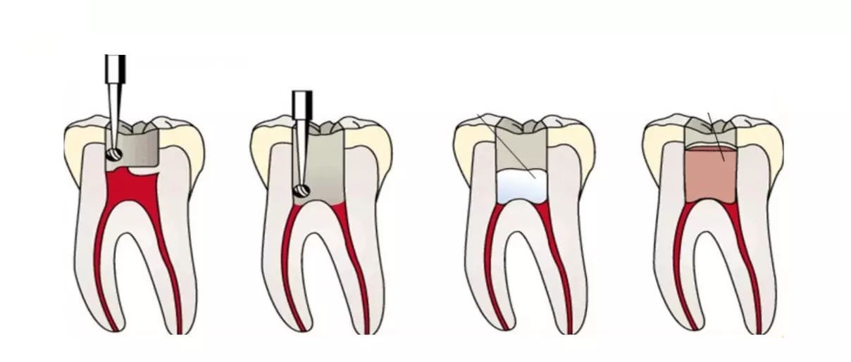 Ампутация пульпы