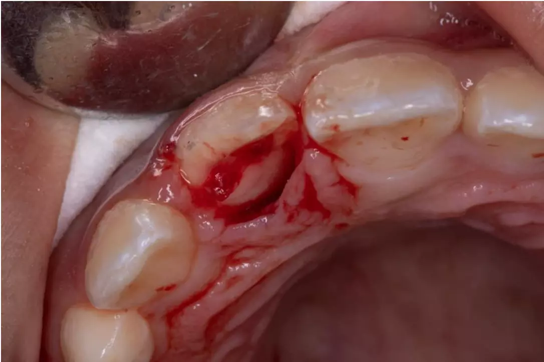 Отлом половины коронки