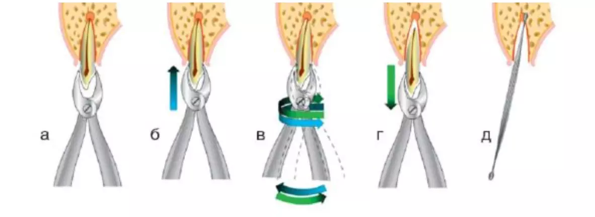 схема удаления постоянных зубов
