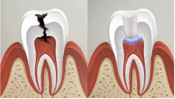 Биологический метод лечения пульпита