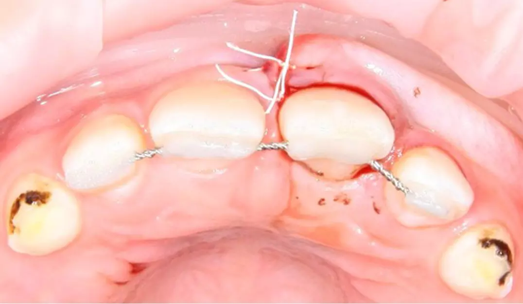 реплантация зуба с последующим шинированием