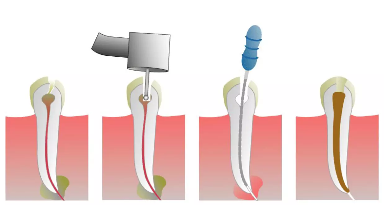 Обобщенная схема эндодонтического лечения