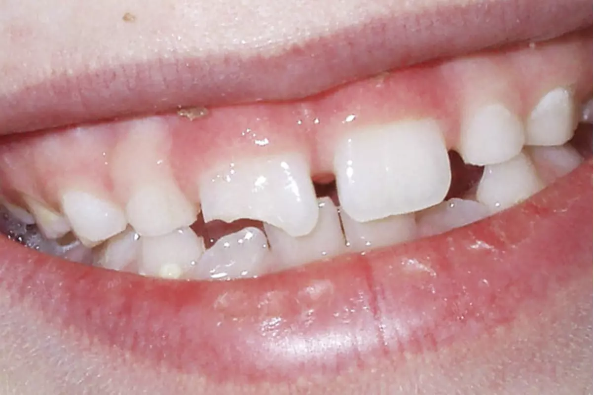 травма молочного зуба