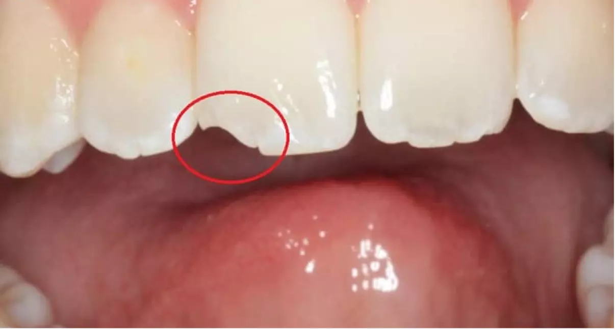 пример скола эмали