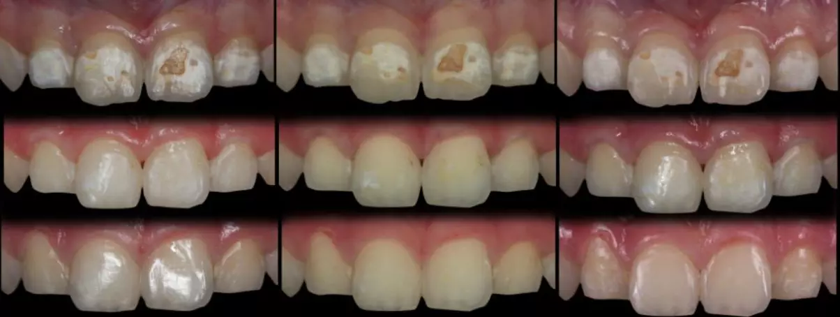 Пример лечения сколов с помощью ICON