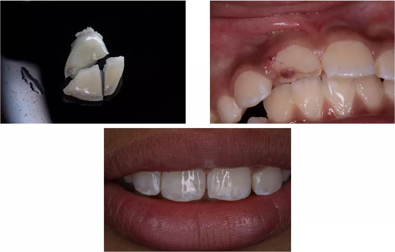 Пример восстановления зуба фрагментами после травмы