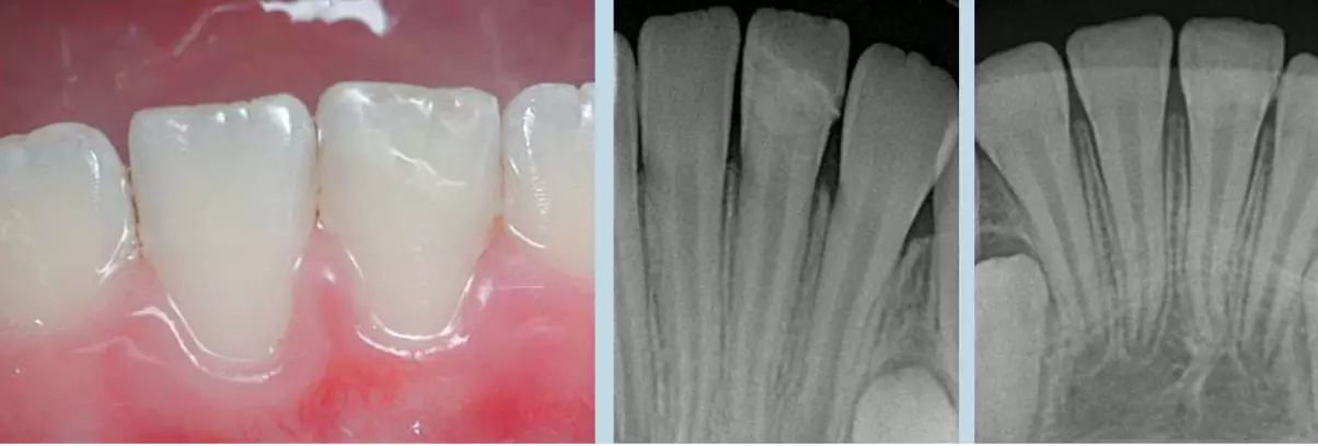Пример реставрации фрагментом зуба