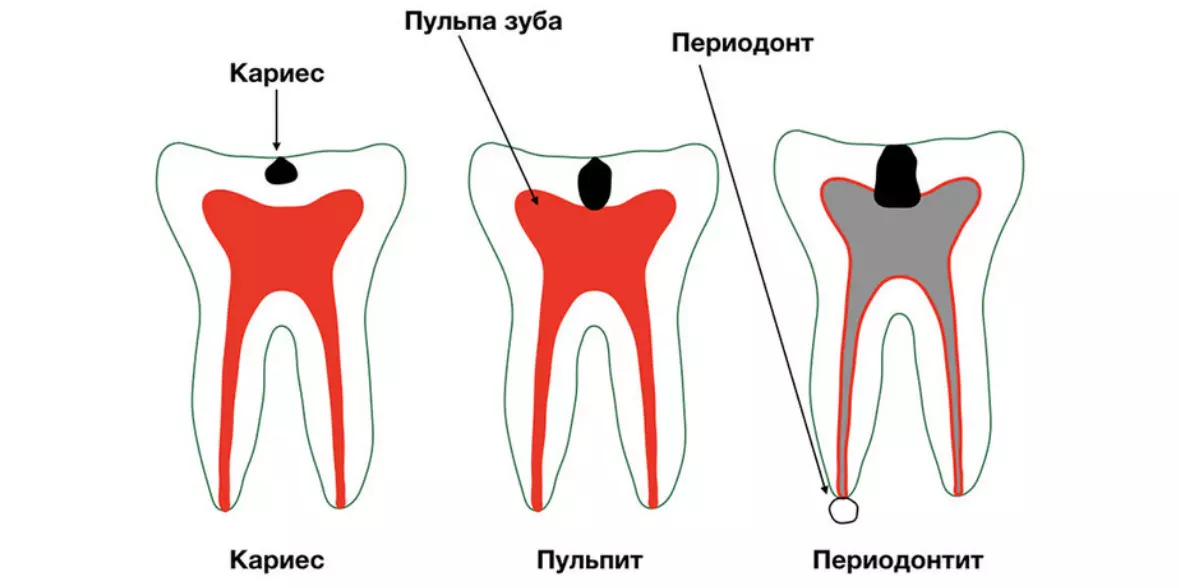 Причины периодонтита