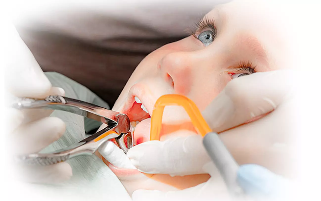 удаление молочного зуба