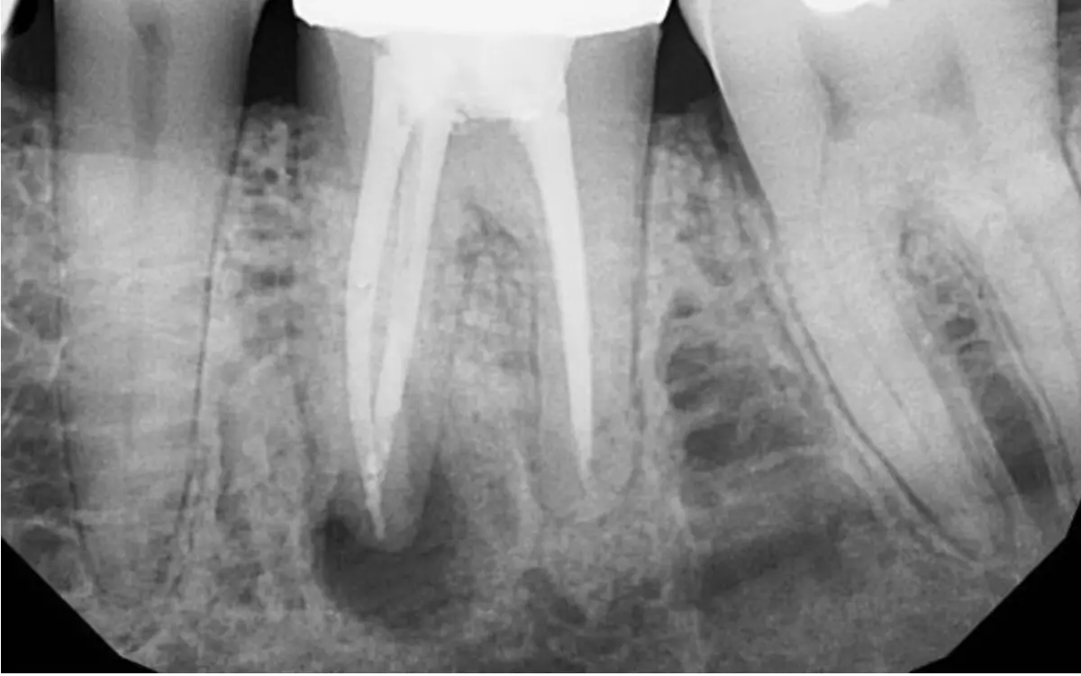 Круглый очаг поражения на верхушке зуба