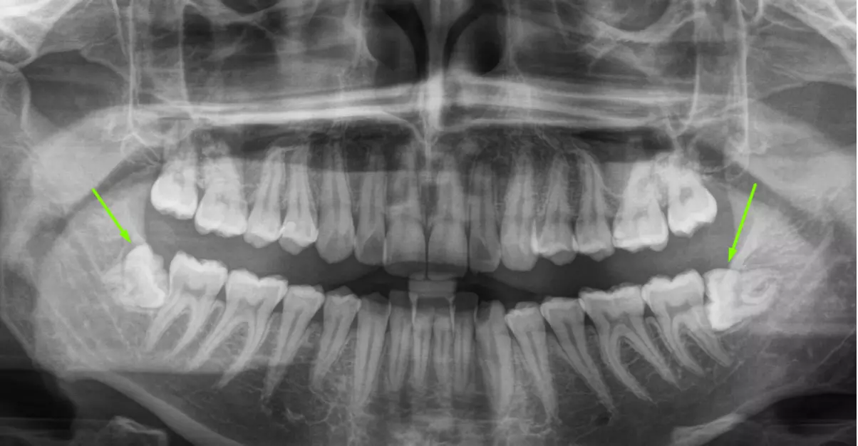 восьмерки на рентгене