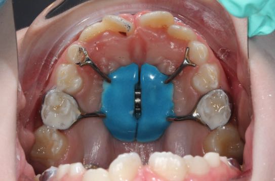 Аппарат Марко-Росса