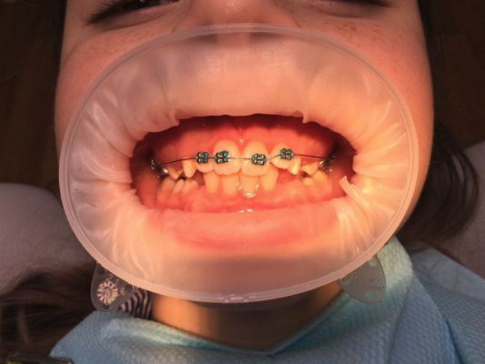 Лечение в технике 4+2