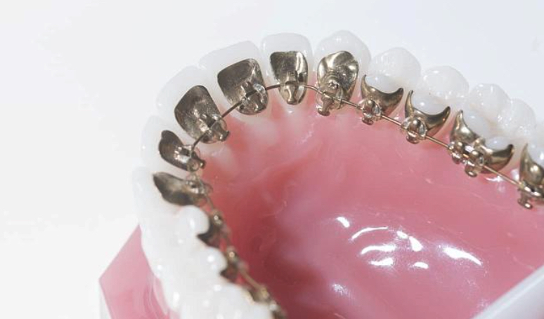 Локализация брекетов