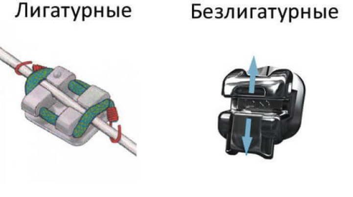 Метод фиксации дуги