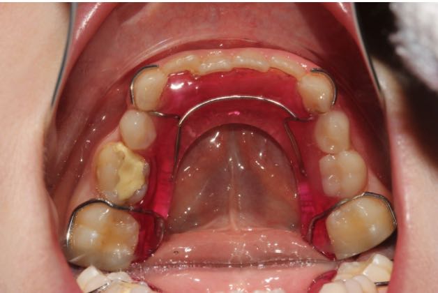 Пластиночные аппараты