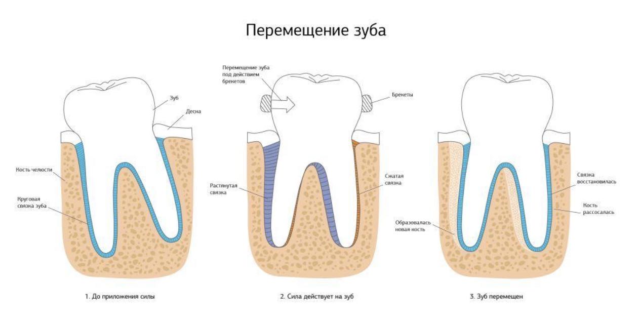 Установка ретейнеров