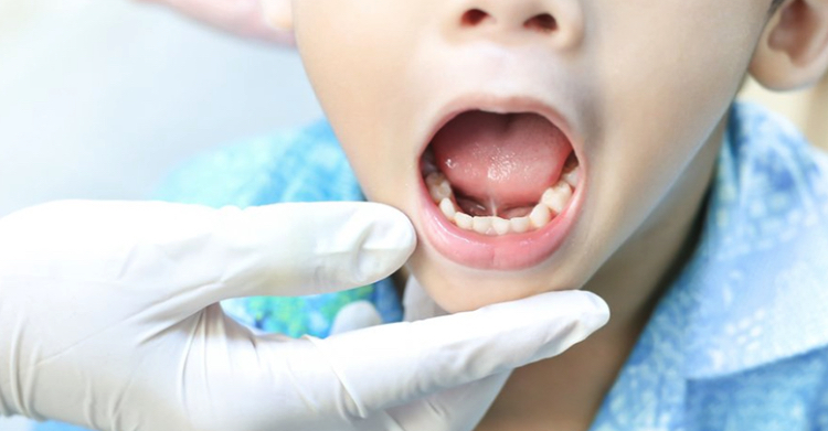 Пластика уздечки языка