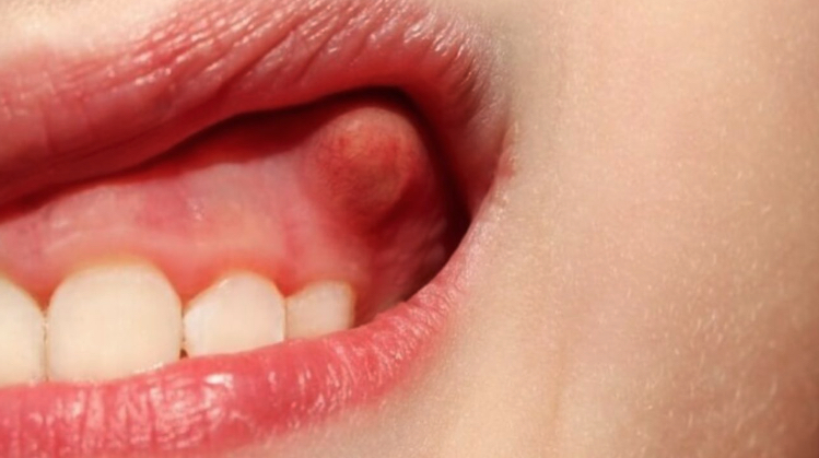 Розтин абсцесу