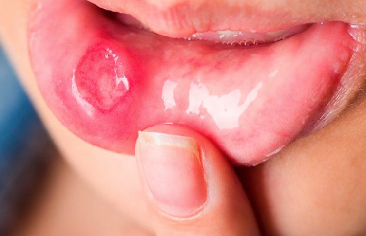 Лечение травмы слизистой полости рта