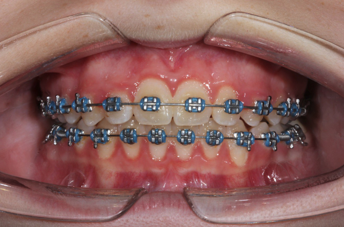 Встановлення брекет-системи