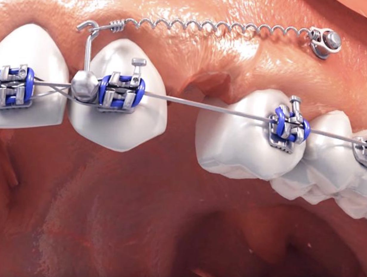 Встановлення мікроімплантів