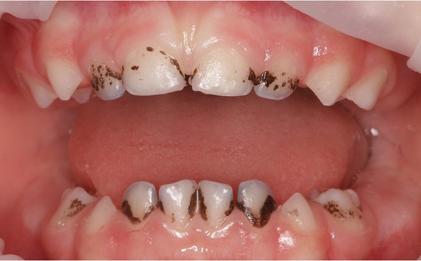 Темный налет на зубах: причины появления и способы устранения