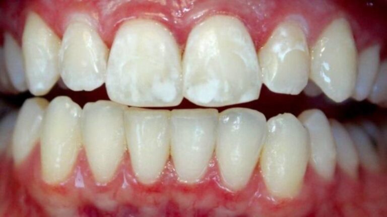 Деминерализация зубной эмали: процессы разрушения твердых тканей зуба