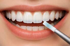 Как укрепить зубную эмаль?