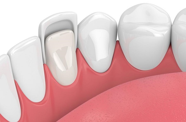 Нужно ли менять виниры?