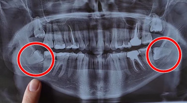 Ретинированный зуб мудрости