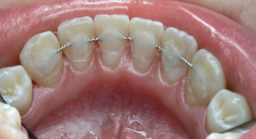 Чому потрібно носити ритейнери